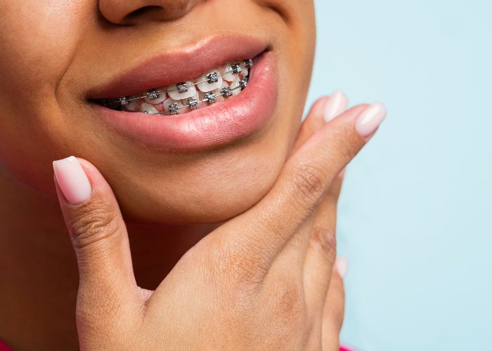 girl smiling with braces and her hand under her chin