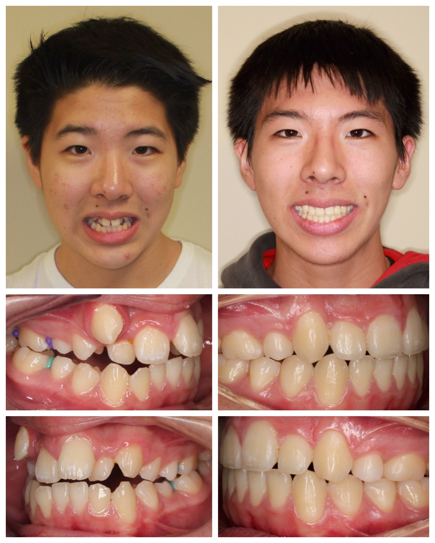 before-and-after braces by dobie revolution orthodontist - hamden and guilford, CT (19)