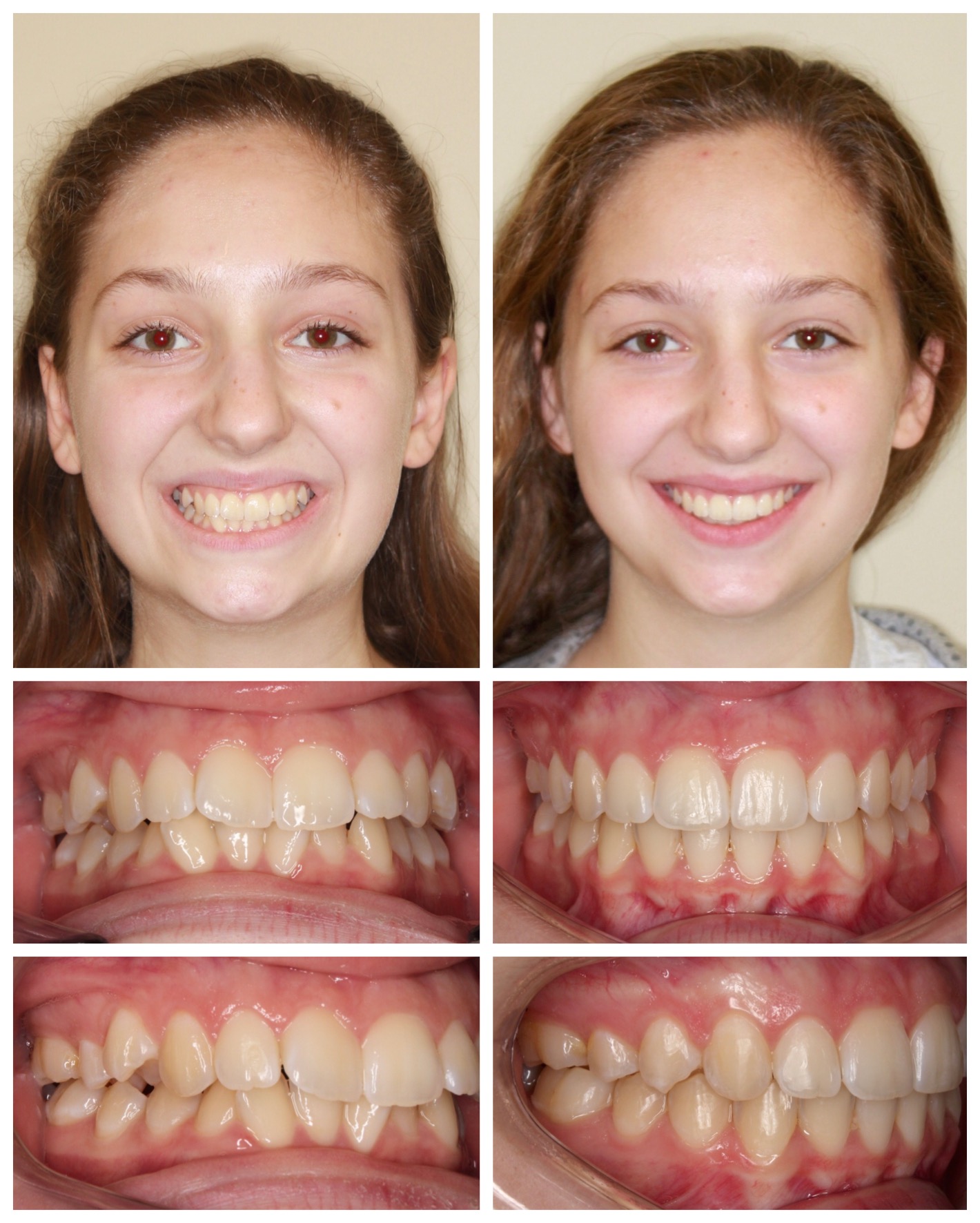 before-and-after braces by dobie revolution orthodontist - hamden and guilford, CT (18)