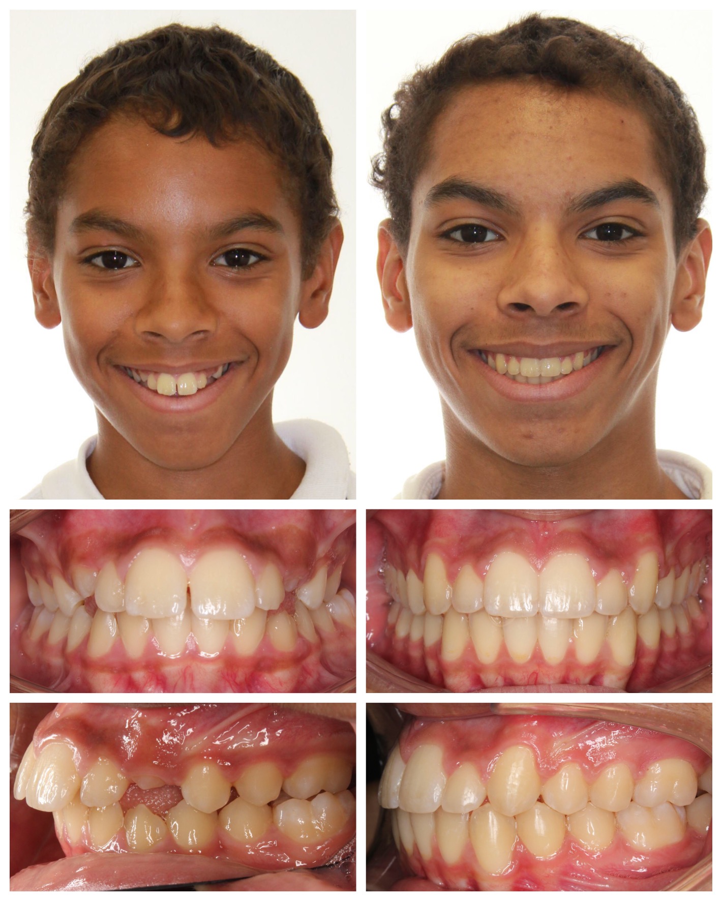 before-and-after braces by dobie revolution orthodontist - hamden and guilford, CT (17)