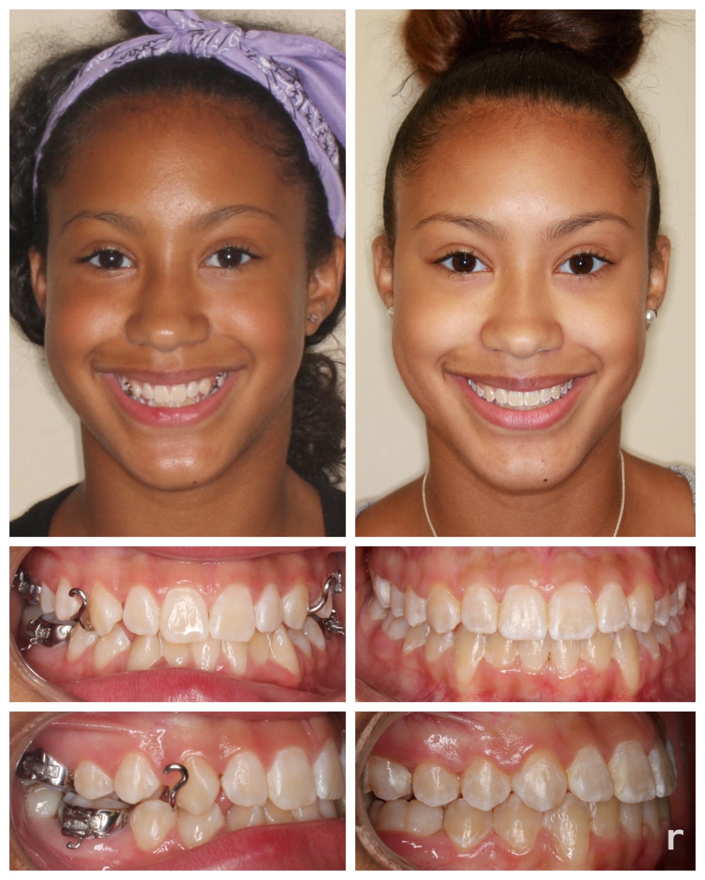 before-and-after braces by dobie revolution orthodontist - hamden and guilford, CT (4)