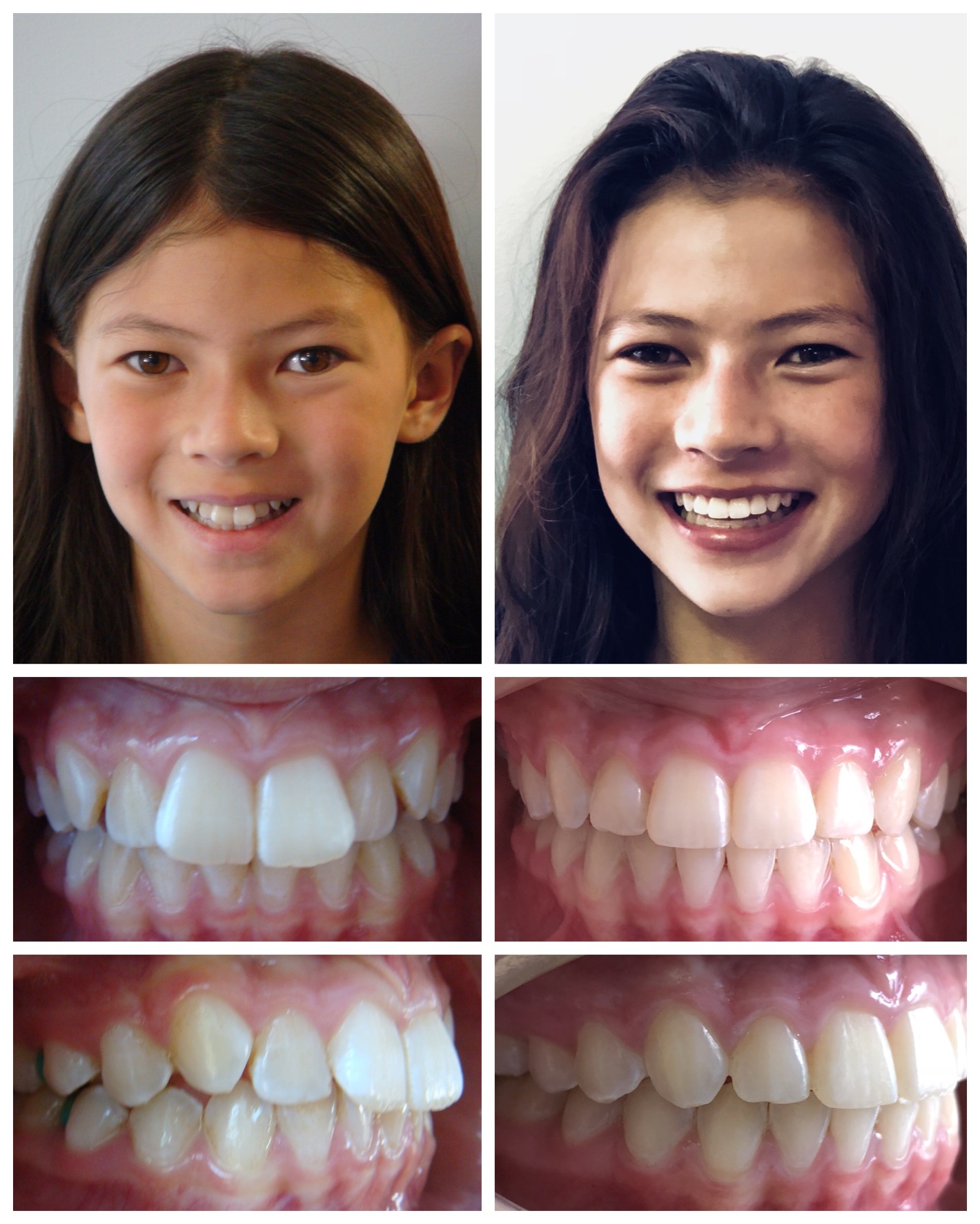 before-and-after braces by dobie revolution orthodontist - hamden and guilford, CT (15)