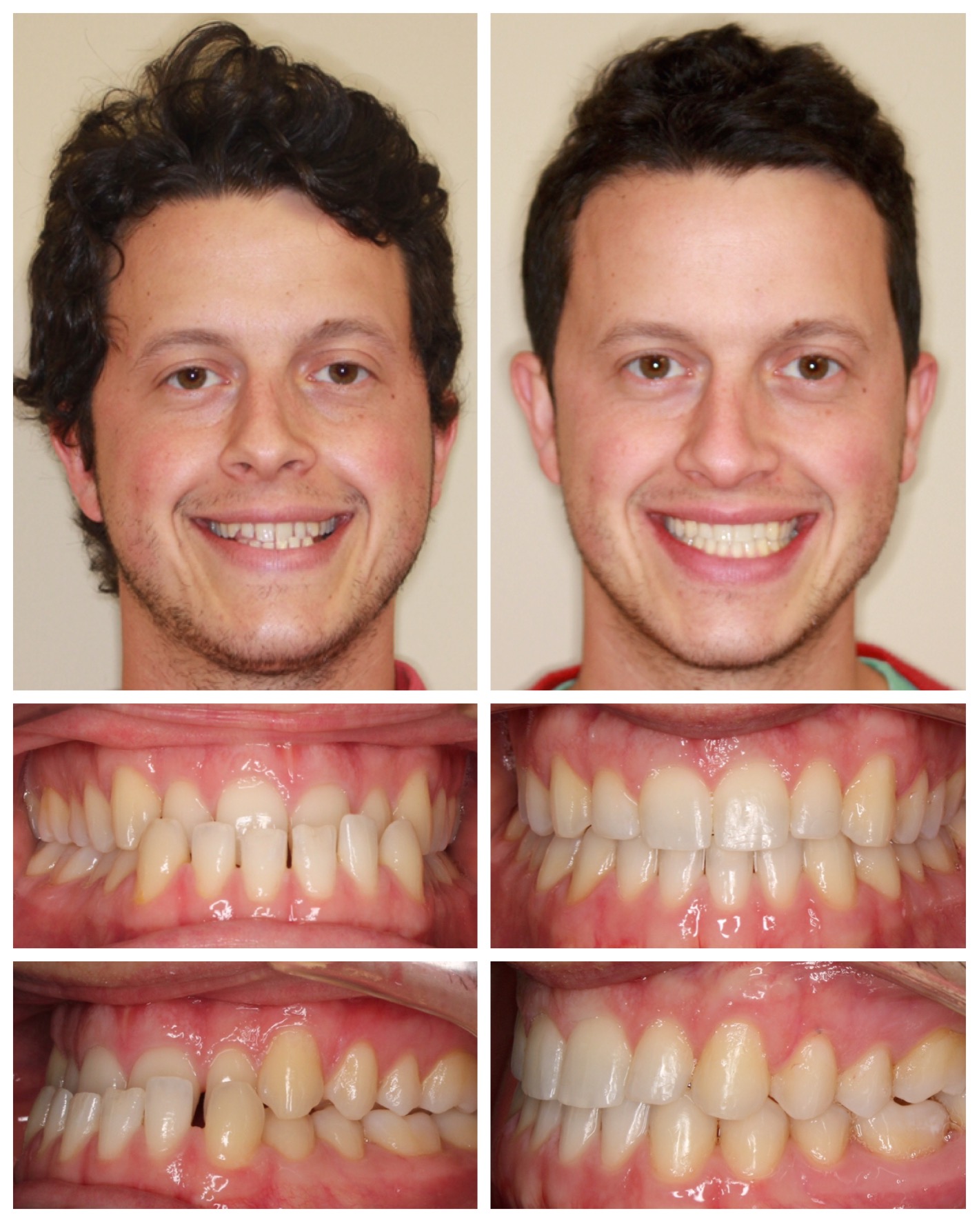 before-and-after braces by dobie revolution orthodontist - hamden and guilford, CT (14)