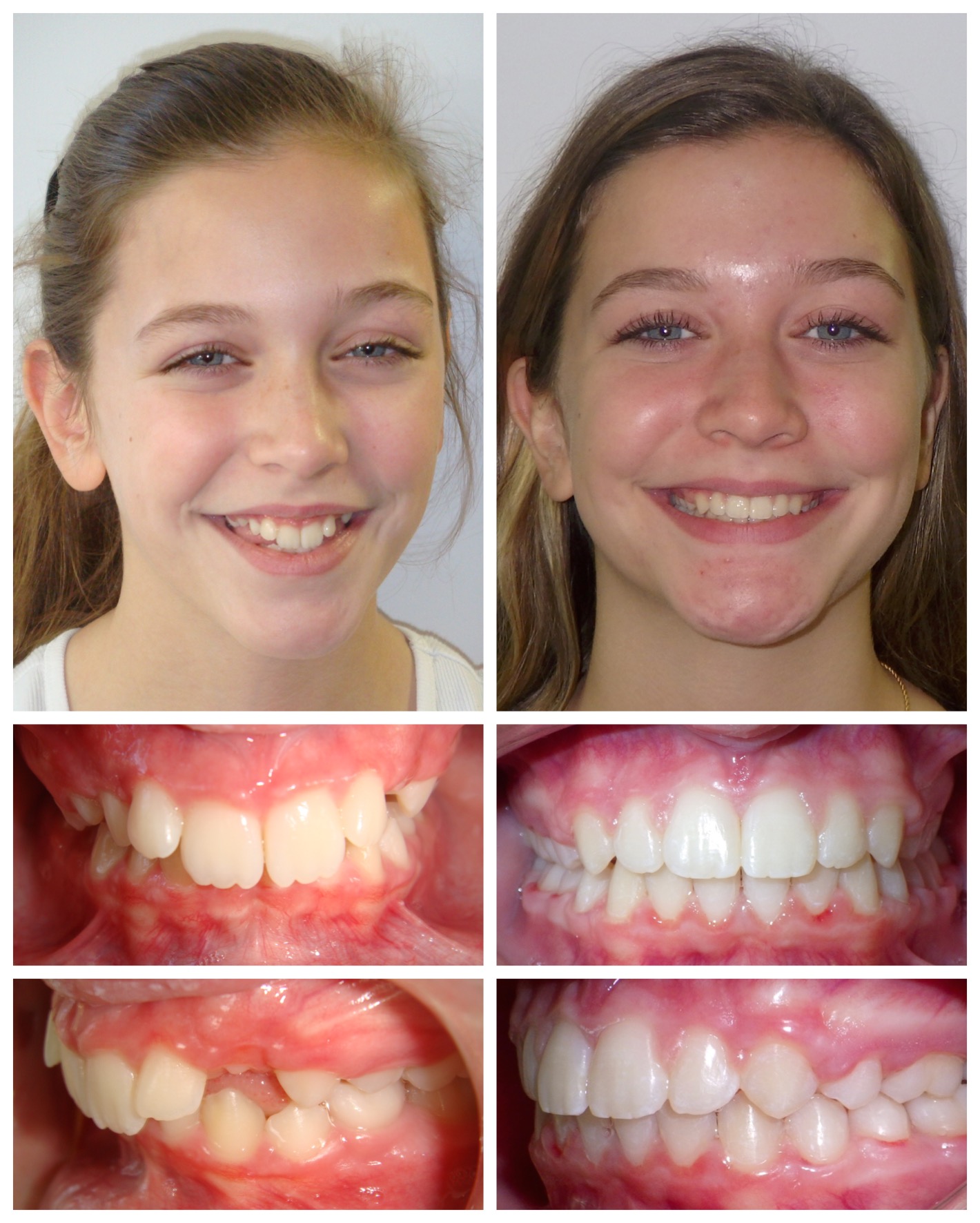 before-and-after braces by dobie revolution orthodontist - hamden and guilford, CT (13)