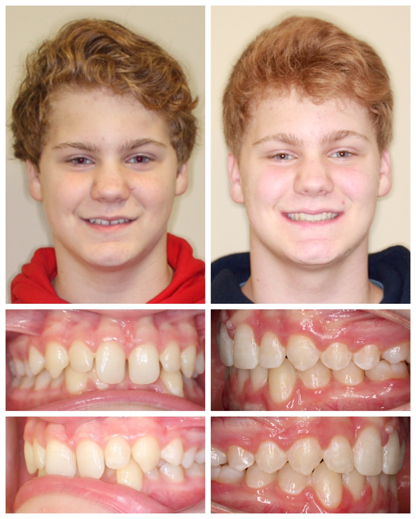 before-and-after braces by dobie revolution orthodontist - hamden and guilford, CT (12)
