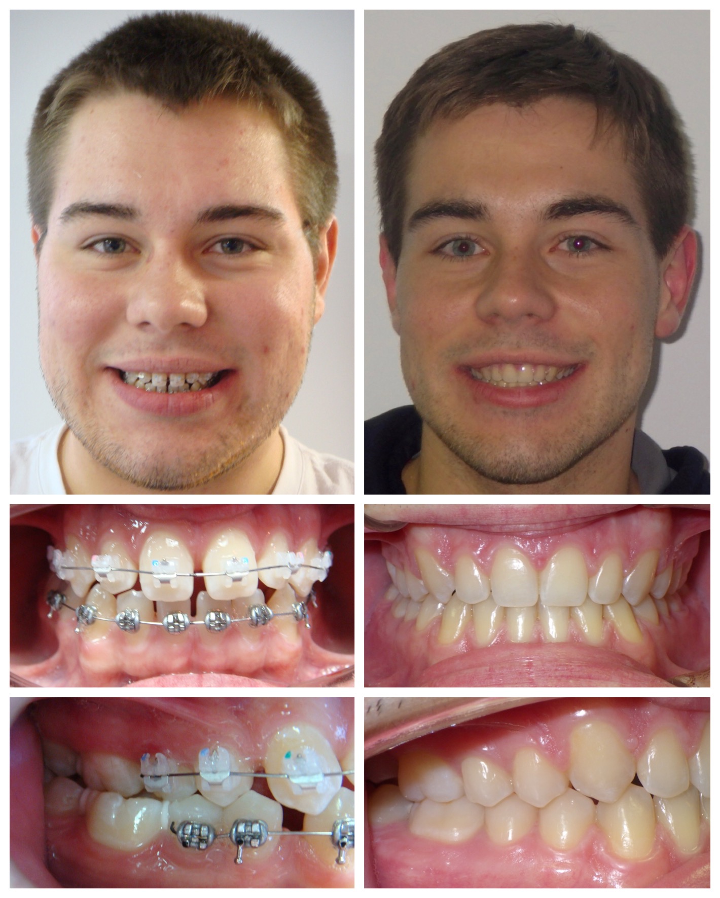 before-and-after braces by dobie revolution orthodontist - hamden and guilford, CT (3)