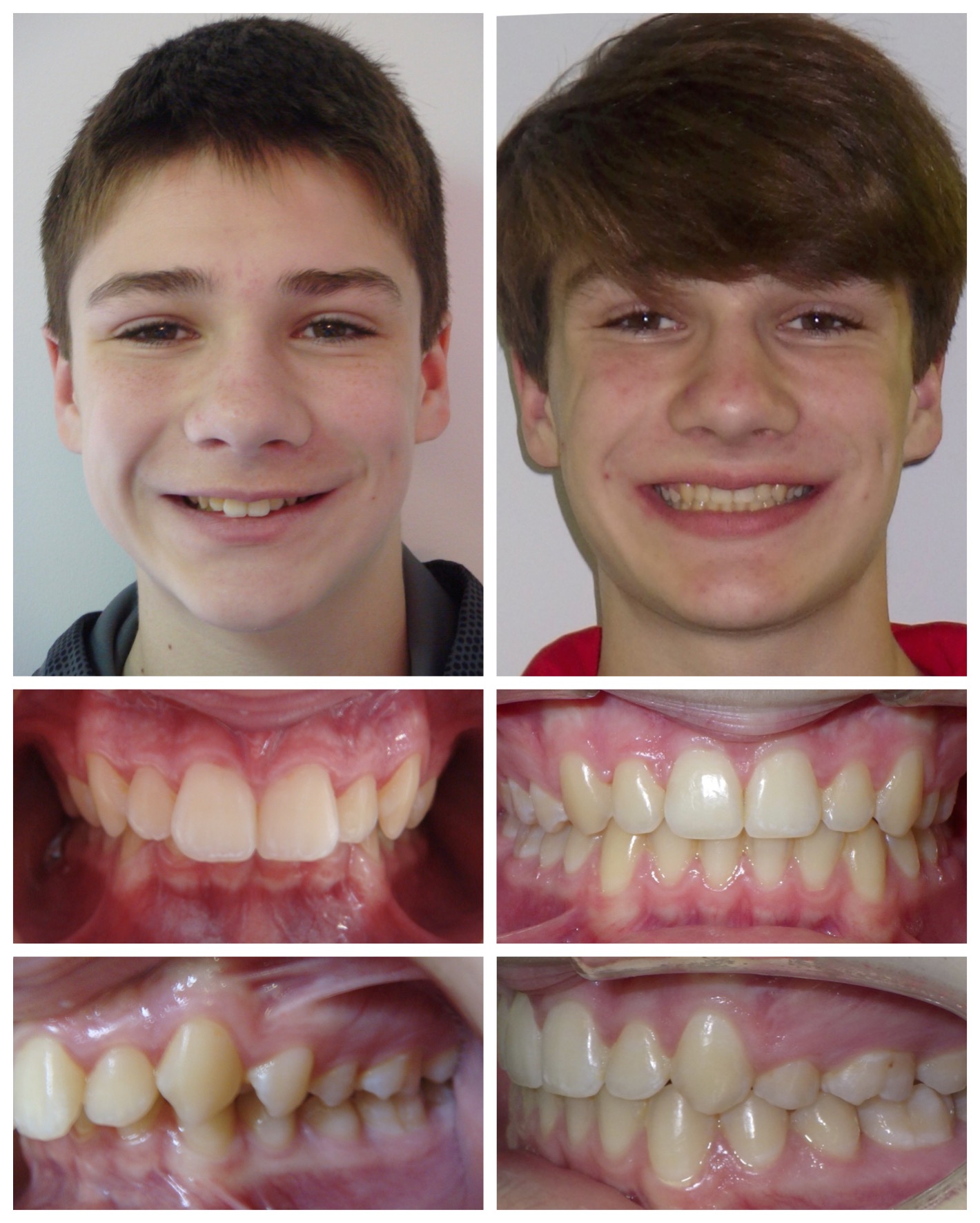before-and-after braces by dobie revolution orthodontist - hamden and guilford, CT (11)