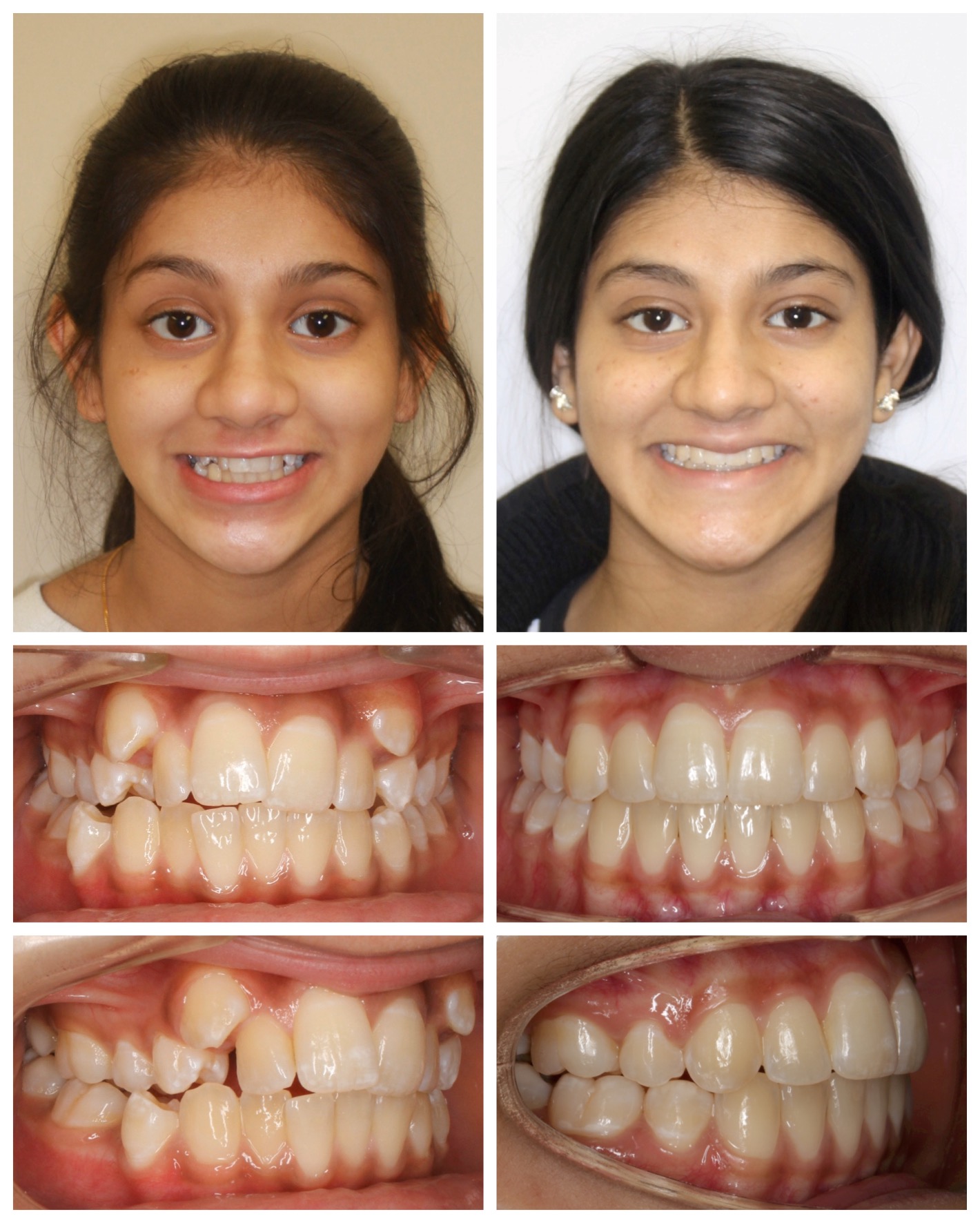 before-and-after braces by dobie revolution orthodontist - hamden and guilford, CT (10)