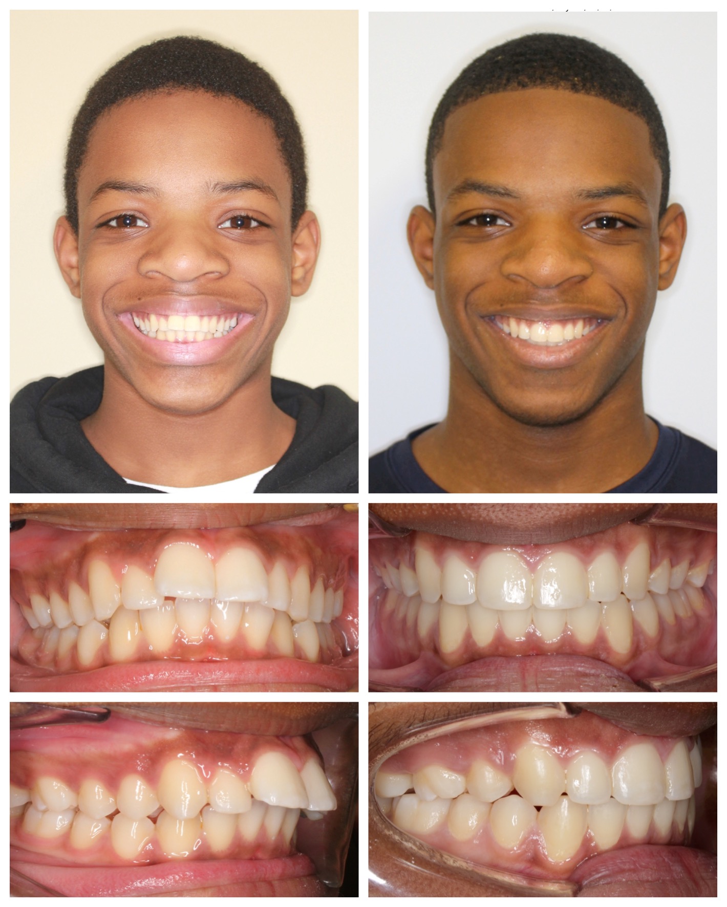 before-and-after braces by dobie revolution orthodontist - hamden and guilford, CT (9)