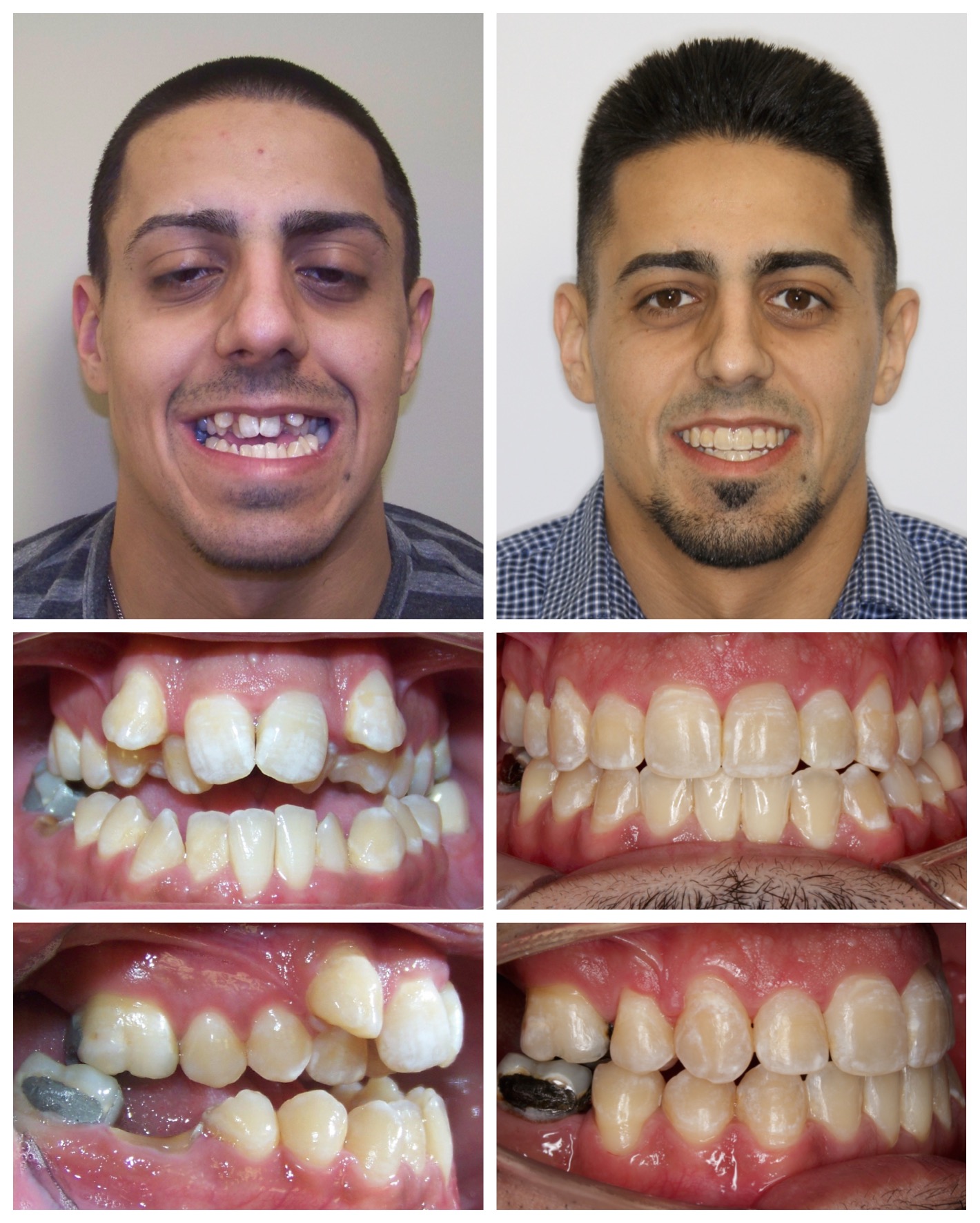 before-and-after braces by dobie revolution orthodontist - hamden and guilford, CT (8)