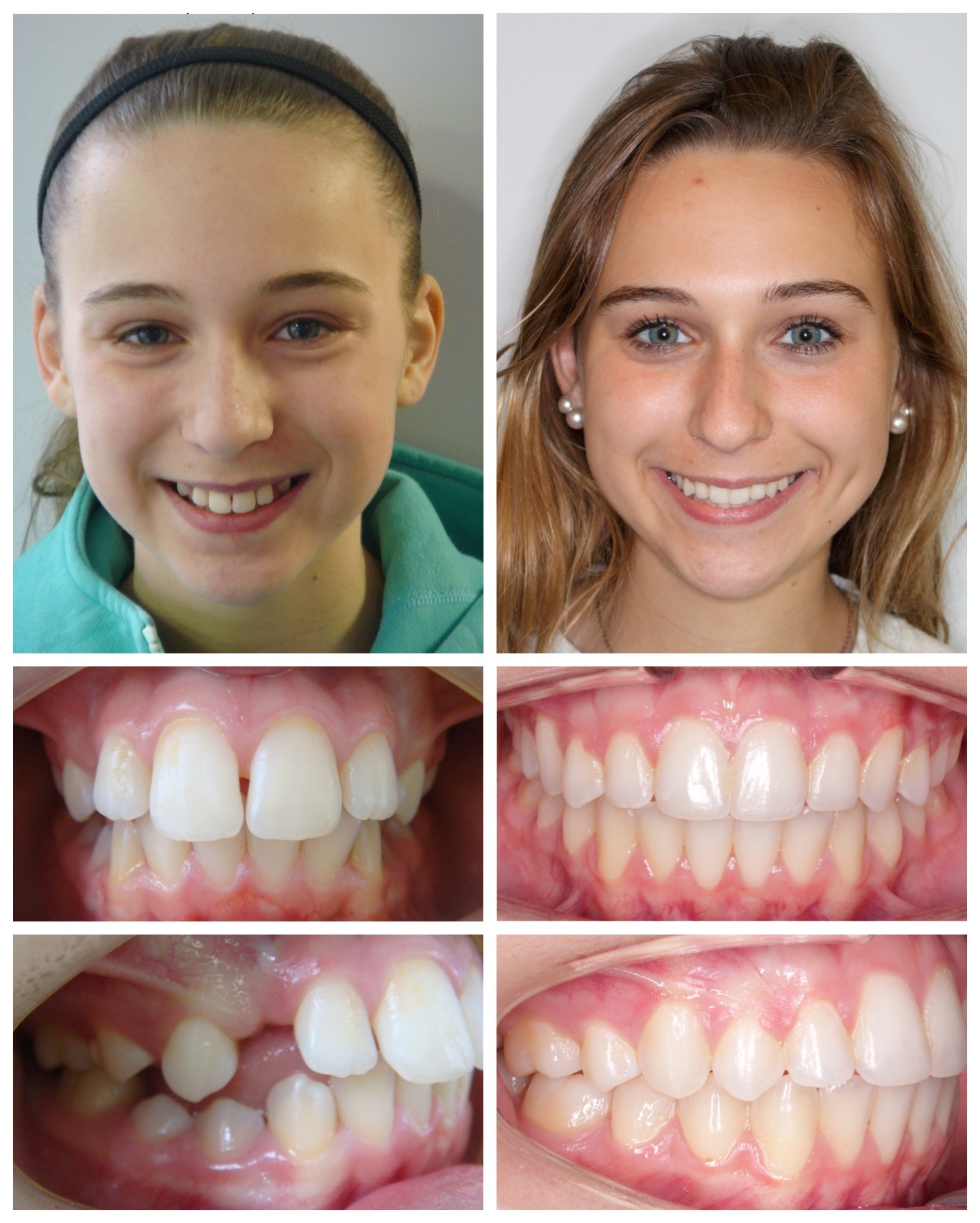 before-and-after braces by dobie revolution orthodontist - hamden and guilford, CT (7)