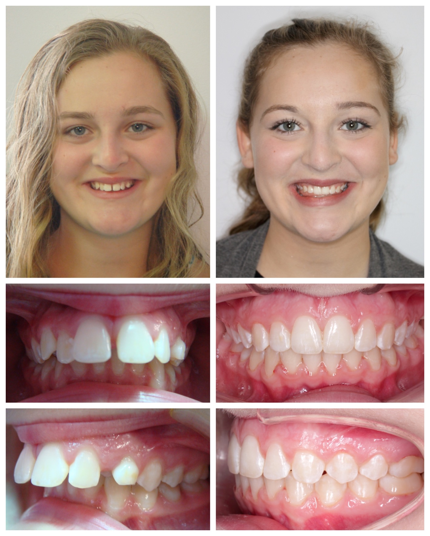 before-and-after braces by dobie revolution orthodontist - hamden and guilford, CT (6)