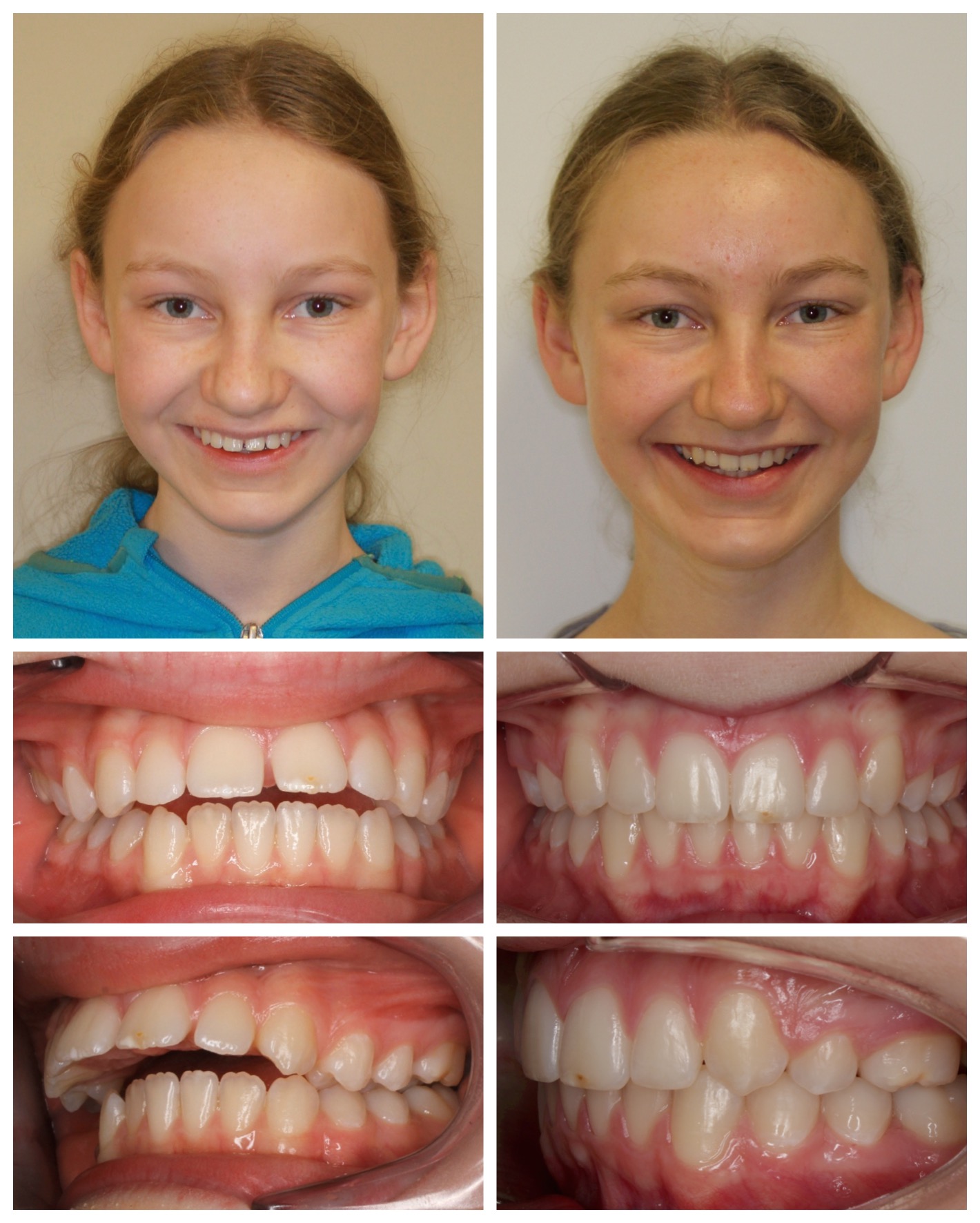 before-and-after braces by dobie revolution orthodontist - hamden and guilford, CT (2)