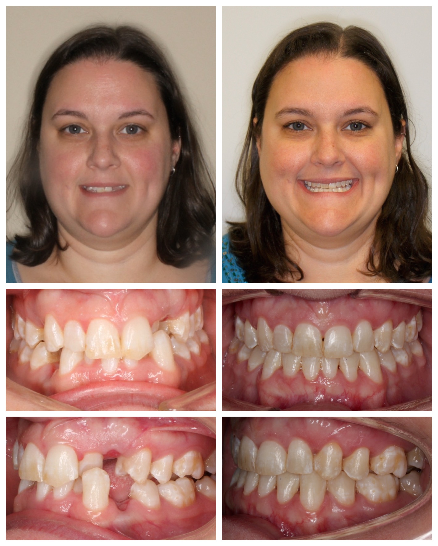 before-and-after braces by dobie revolution orthodontist - hamden and guilford, CT (5)