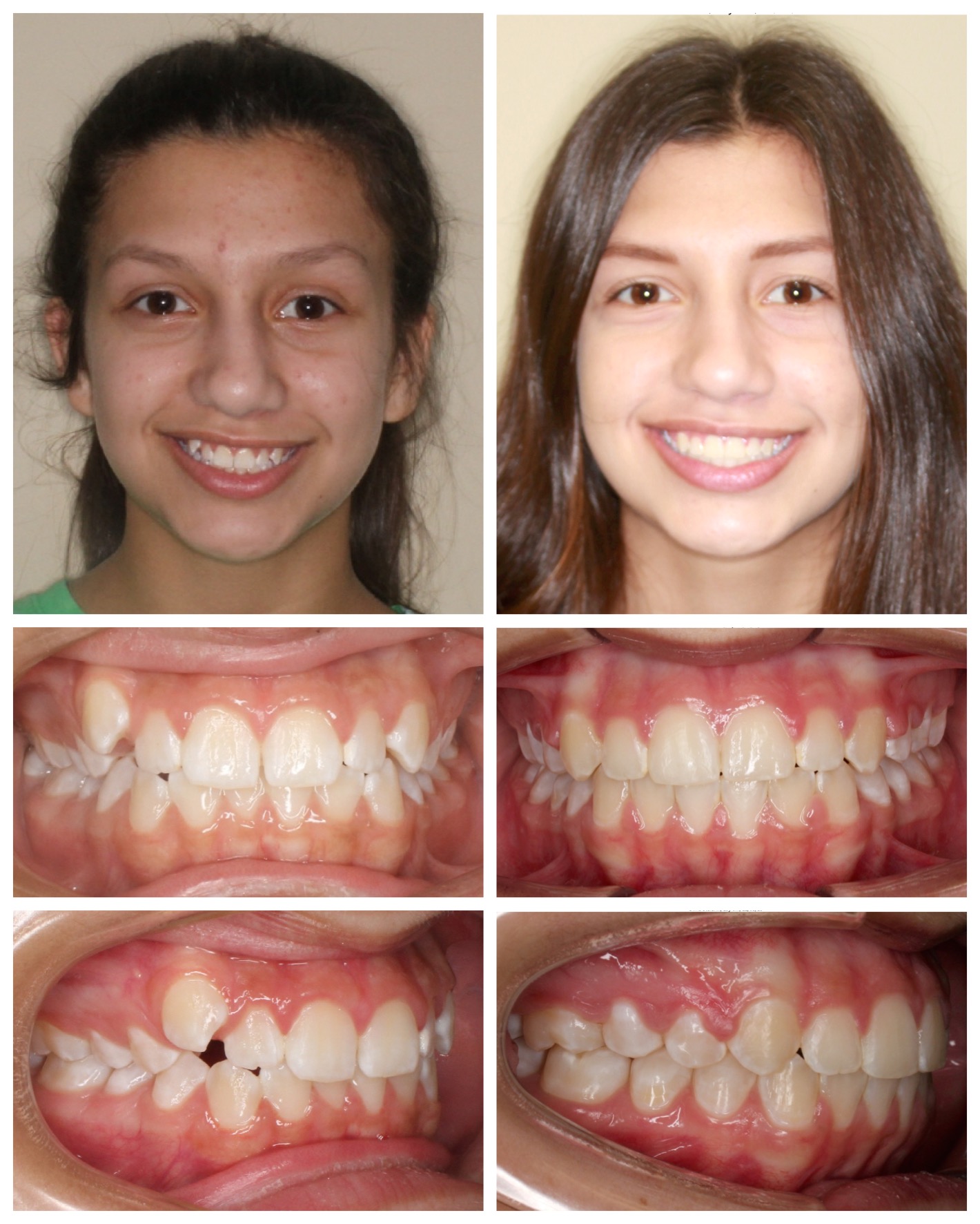 before-and-after braces by dobie revolution orthodontist - hamden and guilford, CT (1)