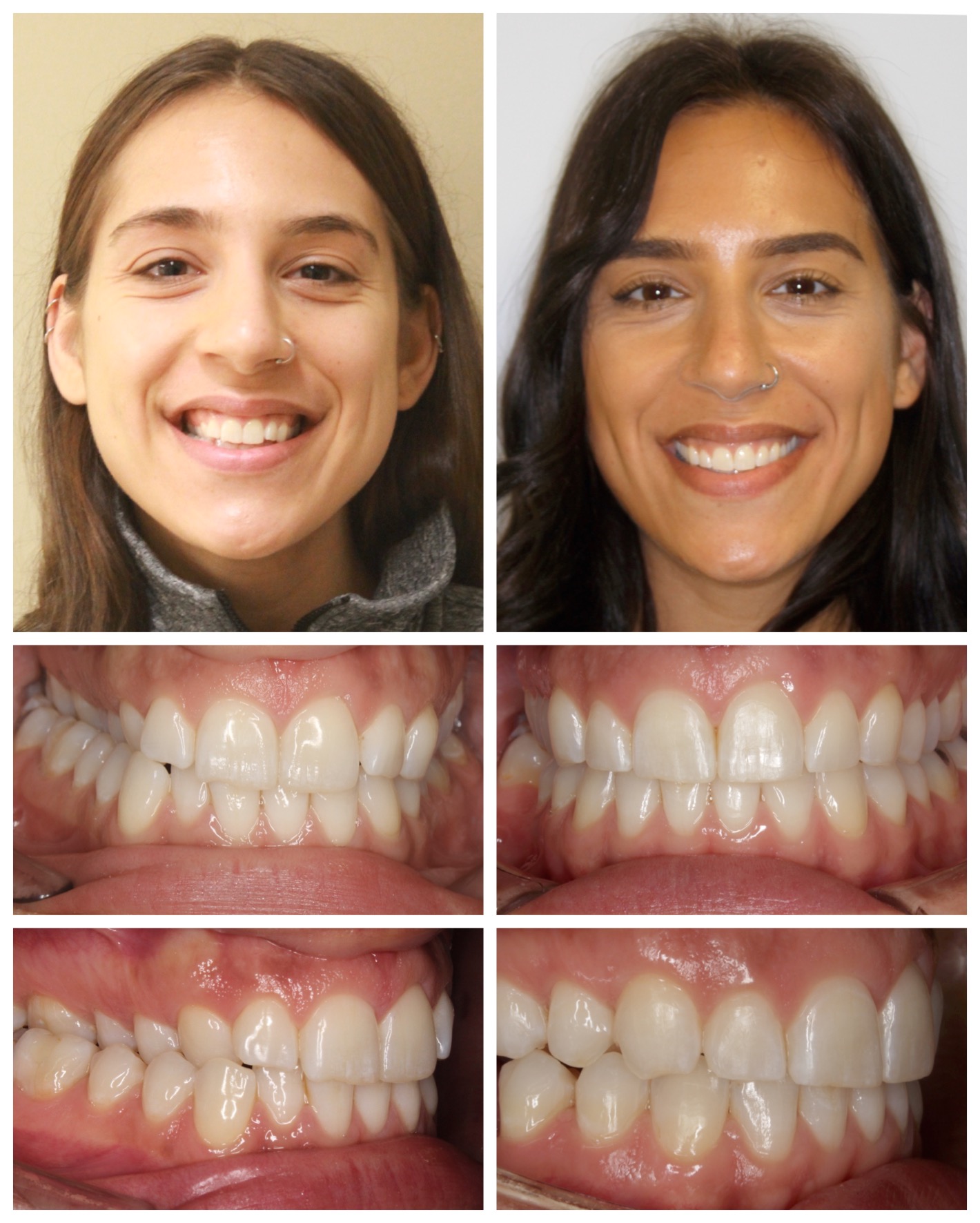 before-and-after braces by dobie revolution orthodontist - hamden and guilford, CT