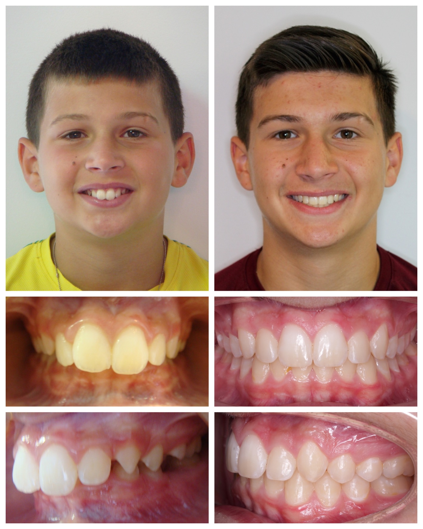 before-and-after braces by dobie revolution orthodontist - hamden and guilford, CT (16)