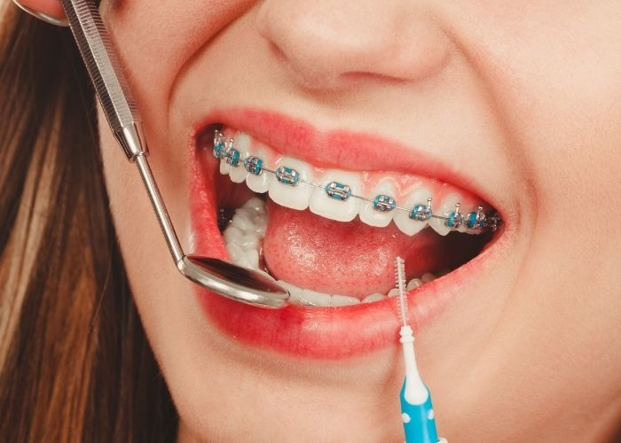 cleaning your braces and teeth properly