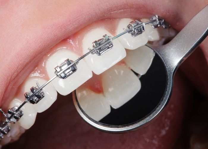 doctor using a mirror to look at the back of a patients mouth wearing metal braces