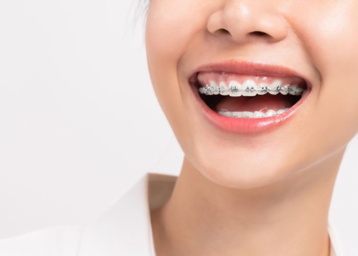 woman laughing wearing braces