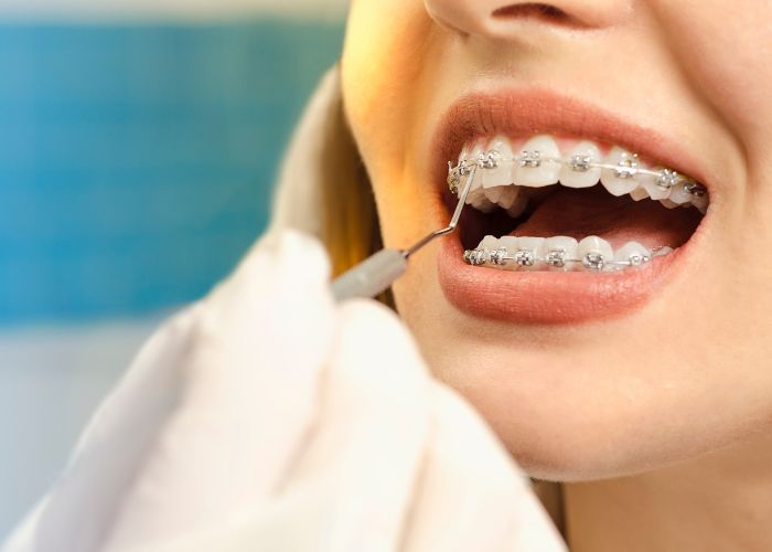 prioritizing dental hygiene for a healthy smile with braces