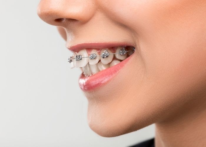 girl with overbite with metal braces (1)