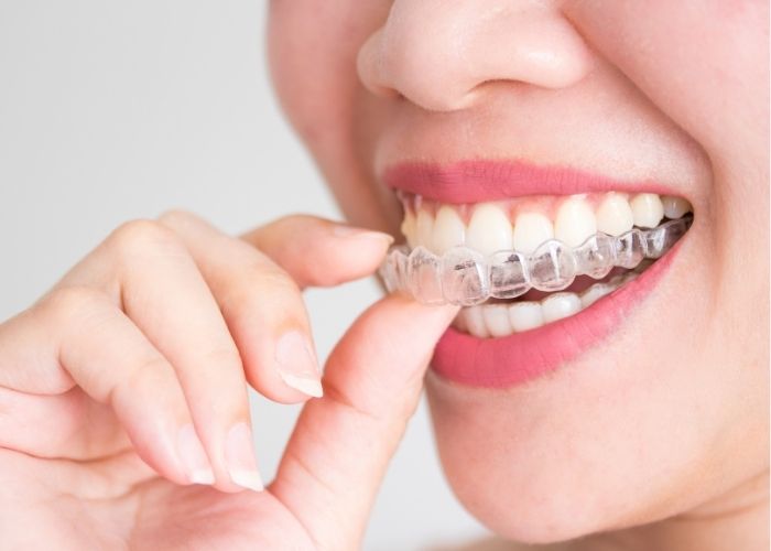 woman putting in invisalign braces