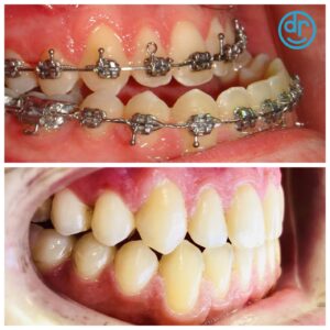 before and after of under bite fixed with braces by dobie revolution orthodontics