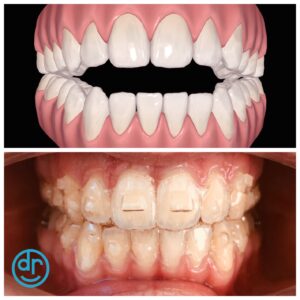 3D scan of a mouth before braces by dobie revolution orthodontics