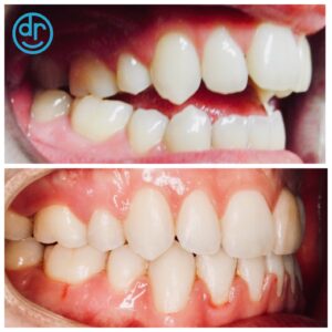 before and after of crooked and straight teeth after braces from dobie revolution orthodontics