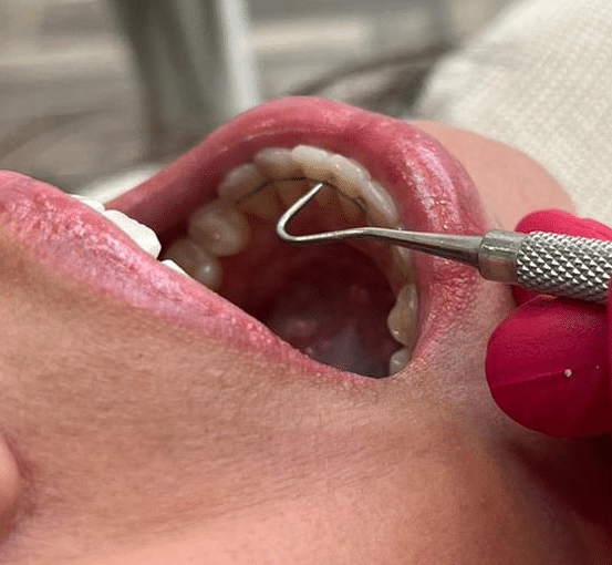fixed-retainer in mouth fixed-retainer in mouth