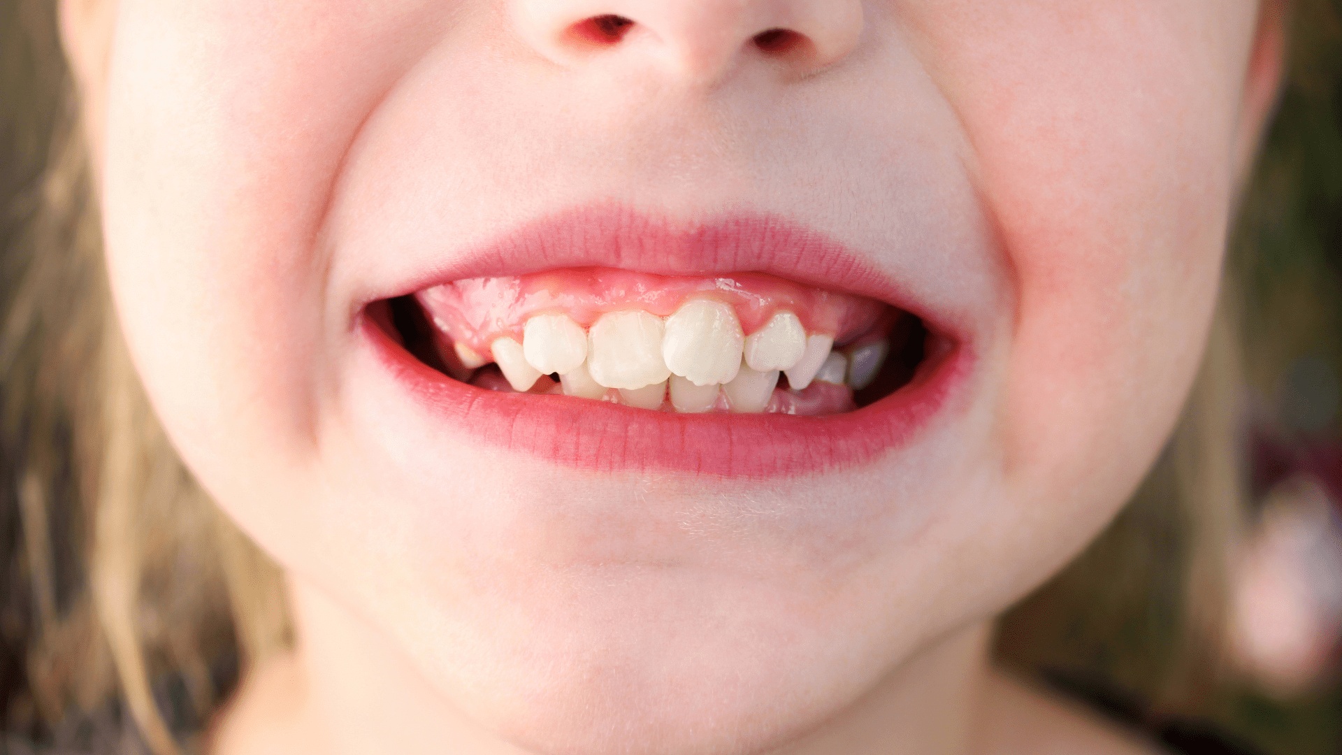 kid crowded teeth kid crowded teeth