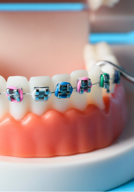 colored metal braces on a model mouth